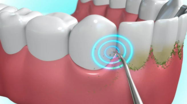 Sonic Pic Dental Cleaning System – NexusQualitystore