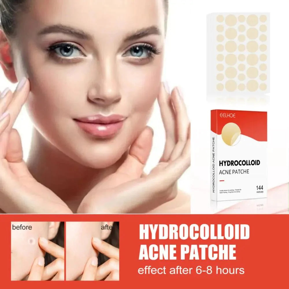 Hydrocolloid Acne Pimple Patch – NexusQualitystore